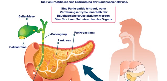 Pankreatitis